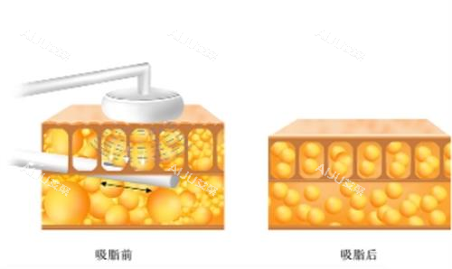 吸脂前后对比图