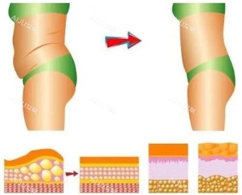 吸脂过程前后示意图