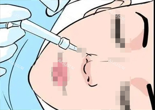 玻尿酸注射鼻子动画展示