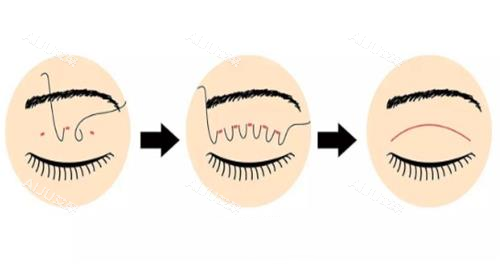 埋线双眼皮演示图