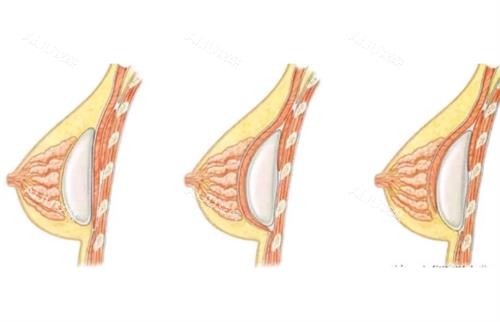 假体隆胸动画图示