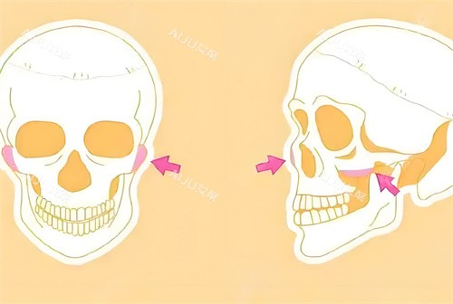 颧骨手术磨骨部位骨头演示动画图