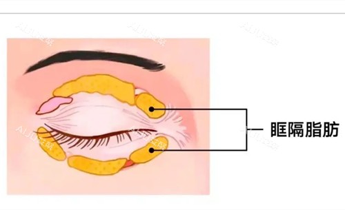 眼周眶隔脂肪卡通示意图