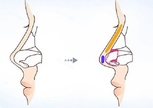 鼻小柱延长结构示意图