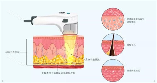 半岛超声炮与黄金超声炮的区别有哪些？在成效/技术原理/能量频率/治疗深度等方面大有不同