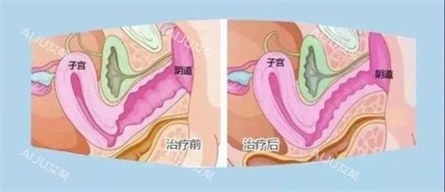 缩阴手术前后对比动画图