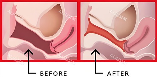 阴道紧缩手术前后对比动画图
