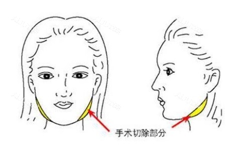 方脸削骨部分