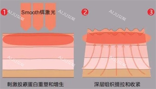 刺激胶原深层提拉