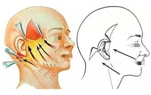 拉皮手术缝合前后示意图