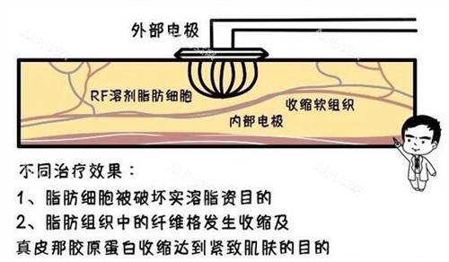 钻石超塑溶脂的两大成效：瘦身+紧肤，仅需2000元起可维持6~12个月