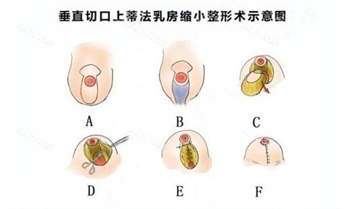 缩胸手术