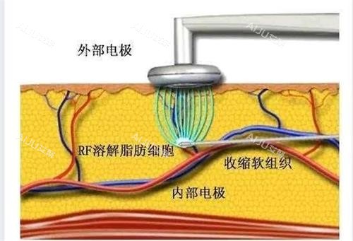 黄金微雕原理