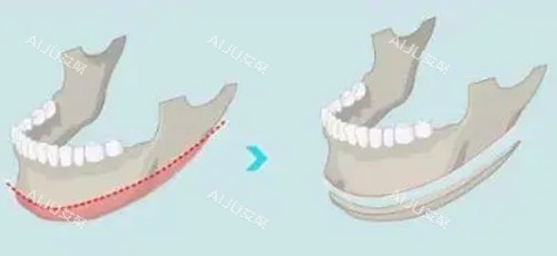 下颌角长曲线截骨前后对比