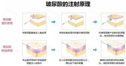 下巴打玻尿酸好还是做假体好？从成效|维持时间|可靠性|舒适度|适应症教你选择