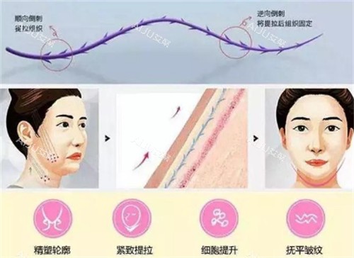 探索面部提升的方法有哪些？分手术|非手术两种方式，手术包含埋线提升/悬吊/拉皮手术