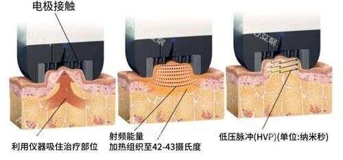 钻石超塑溶脂会反弹吗？不一定，需从技术原理|持久性|生活习惯|后期保养等多个角度来看