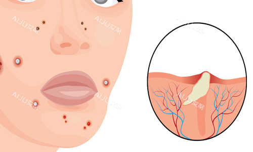 痘痘皮肤示意图