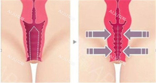 私密紧缩手术前后对比差异