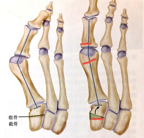 拇外翻传统手术动画展示图