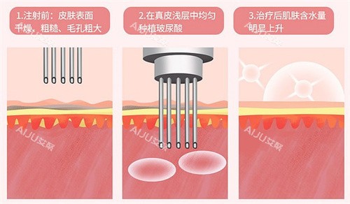 点击查看富勒烯水光的功效与作用！更有每针的价格及产地一览