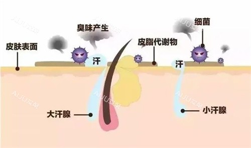 杭州除腋臭手术一般多少钱？5000~20000元不等，具体费用还跟手术方式/医院医生/个体差异有关