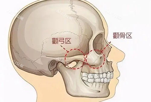 颧弓颧骨位置示意图