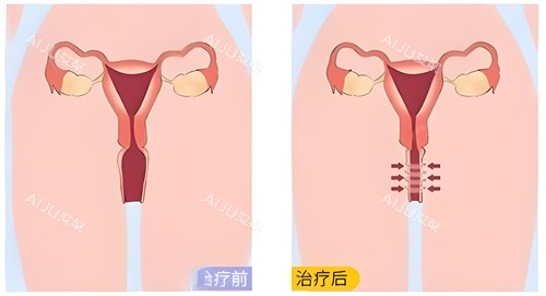 3D生物束带紧缩术原理是什么？来深入探究手术原理+操作过程+优势以及结果解析