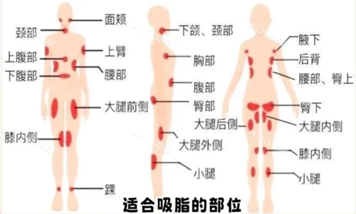 适合吸脂的部位