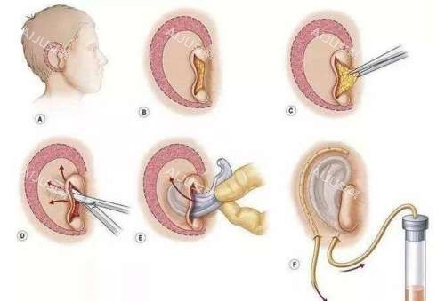 耳再造手术演示动画图