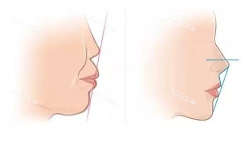 鼻基底矫正前后对比示意图