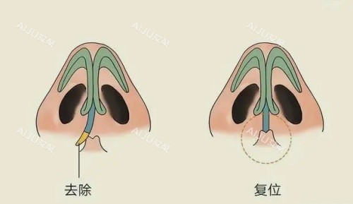 歪鼻修复矫正