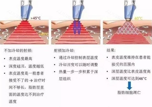 RET内脏溶脂仪器施术过程图解