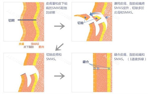 揭秘全程~我在北京加减美做微拉美提升是什么体验?术前、术中、术后全记录,给姐妹上车参考