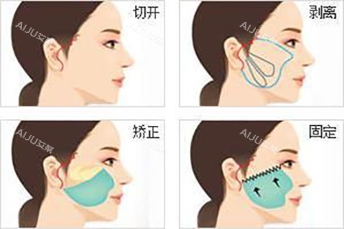 面部耳际小切口拉皮示意图