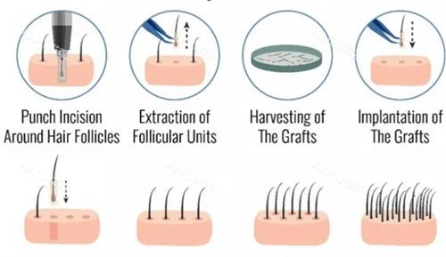毛发移植过程图解