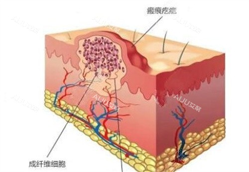 疤痕疙瘩怎么形成的