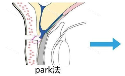 Park法双眼皮