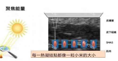 超声王单点释能