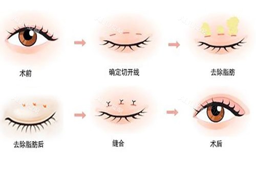 切开式双眼皮过程