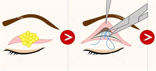 割双眼皮去除脂肪过程示意图