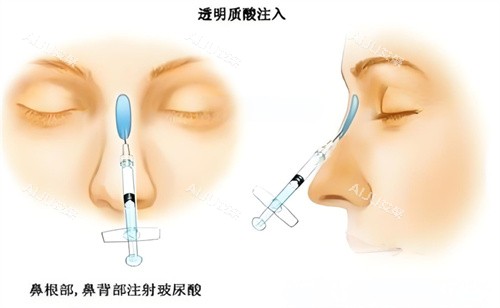 24年温州做隆鼻手术价格表全新发布：注射隆鼻5000+/假体隆鼻8000+/自体软骨隆鼻1.5w+