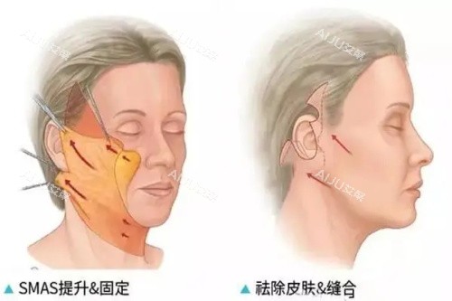 2024长春拉皮手术费多少钱?拉皮手术价格表一览:中面部2W+/mini拉皮1.5W+/小切口拉皮8k+