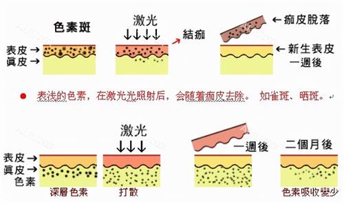 激光祛老年斑后的变化