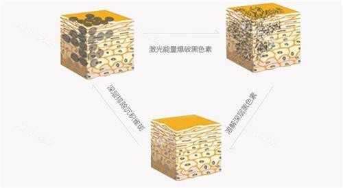 激光祛雀斑的原理