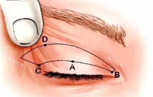 全切双眼皮术前设计