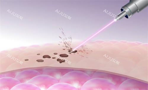 激光祛斑原理图