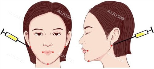 面部注射点位
