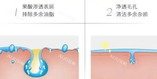 果酸焕肤步骤示意图