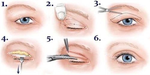 双眼皮全切术过程图